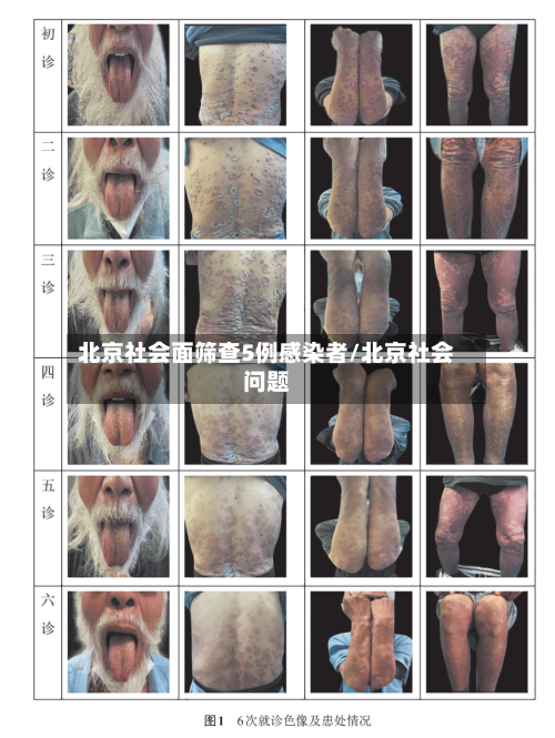 北京社会面筛查5例感染者/北京社会问题-第2张图片
